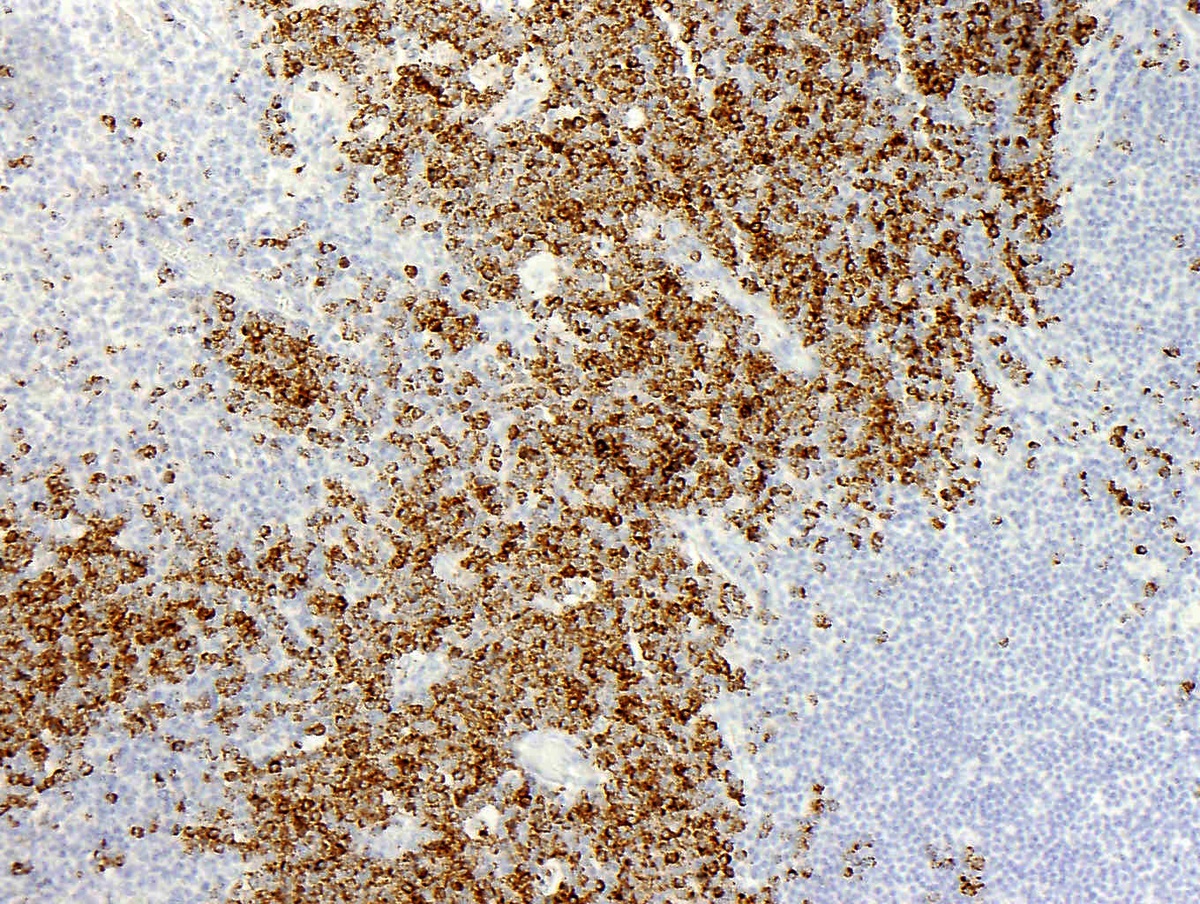 Fig 7: Granzyme B